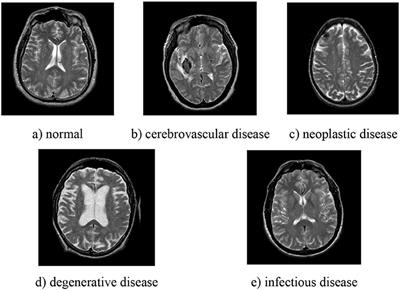 TReC: Transferred ResNet and CBAM for Detecting Brain Diseases